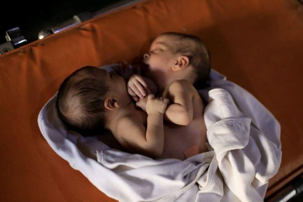Turkey transfers conjoined twins from Syria’s Afrin to separate them